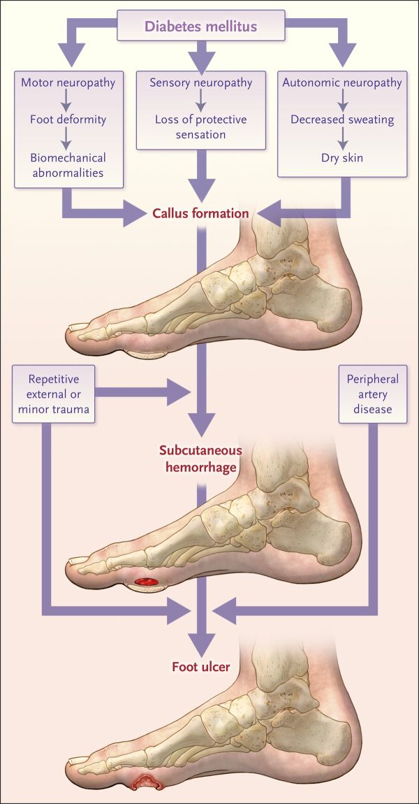 development diabetic ulcus